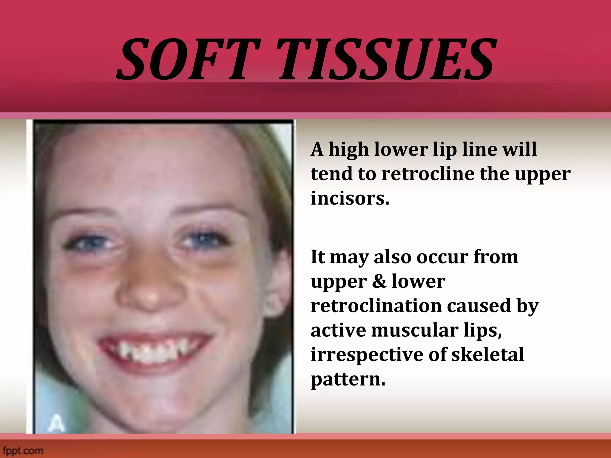 Treatment Of Class Ii Malocclusions Pptx Treatment Of Class Ii Malocclusions Pptx
