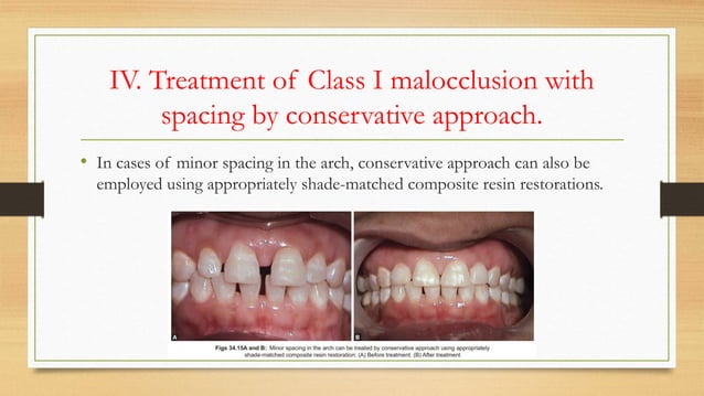 Treatment of Class I Malocclusion .pptx