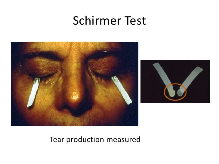 Treatment Of Dry Eye Syndrome