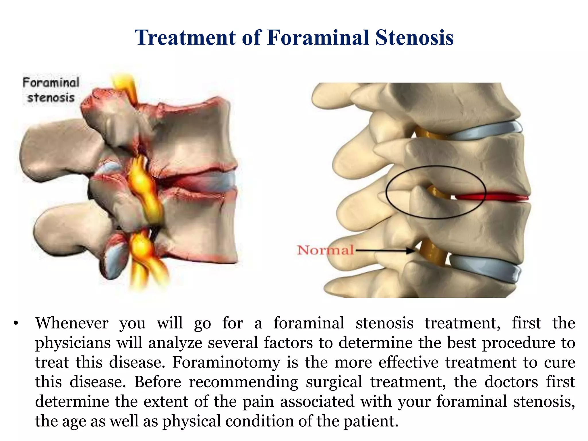 Treatment of foraminal stenosis | PPTX