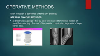 TREATMENT OF FRACTURES By Pooja Ramalingam | PPTX