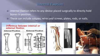 Treatment of fractures and dislocations | PPTX