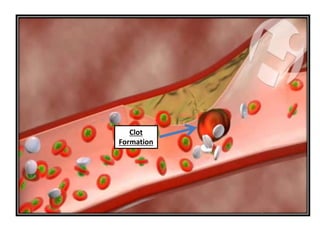 Clot 
Formation 
 