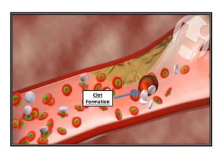 Clot 
Formation 
 