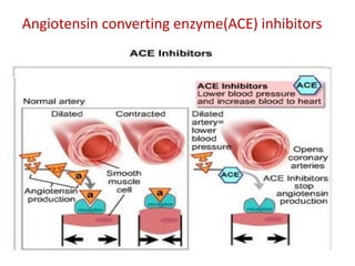 Angiotensin converting enzyme(ACE) inhibitors 
 