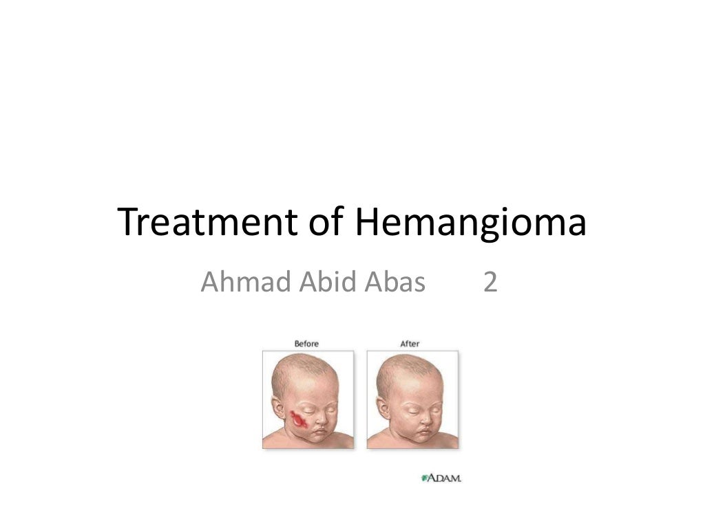 Treatment of Hemangioma