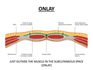 Sublay Only TREATMENT AND MANAGEMENT OF HERNIA | PPTX