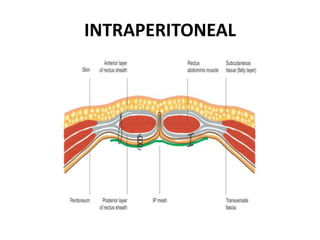 TREATMENT AND MANAGEMENT OF HERNIA | PPTX