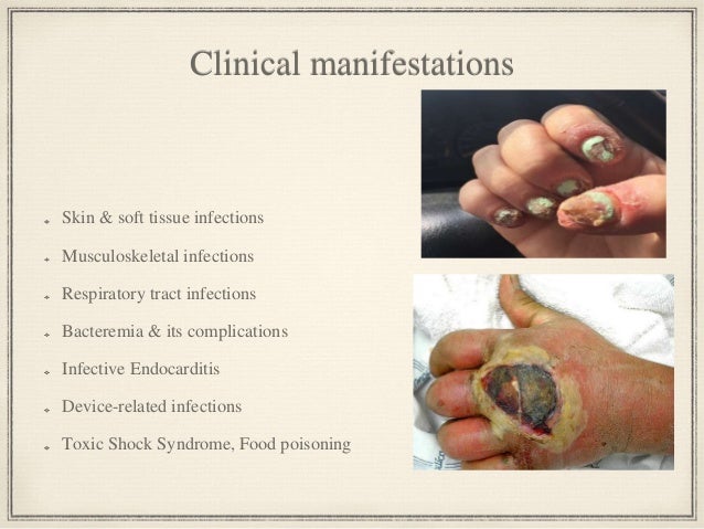 Treatment Of Mrsa Infection