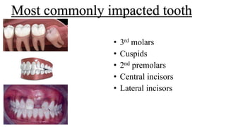TREATMENT OF MULTIPLE IMPACTIONS – ATTEMPT ORTHODONTICALLY 1.pptx