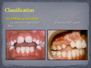 TREATMENT OF OPEN BITE with use of orthodontic appliances | PPT