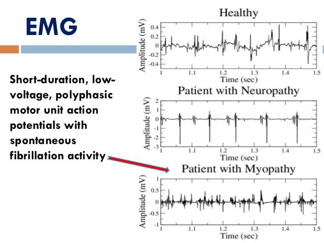 Treatment of resistant & relapsing polymyositis dm