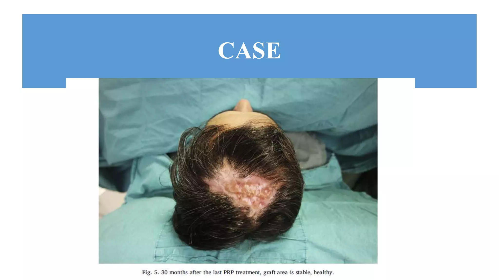 Trephination Ramp Lesion Treatment of scalp defects with a combination of trephination and ...
