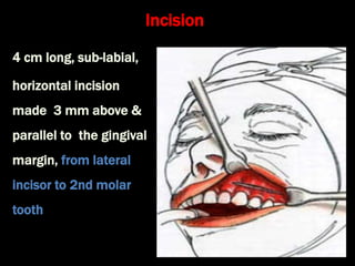 Treatment of sinusitis | PPT