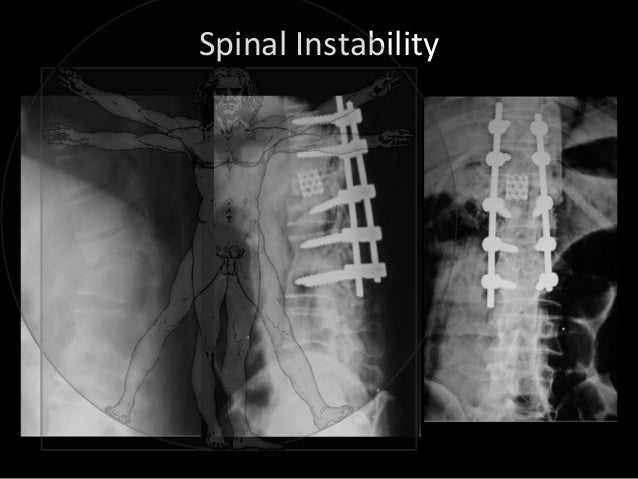 Treatment Of Spinal Tuberculosis - 