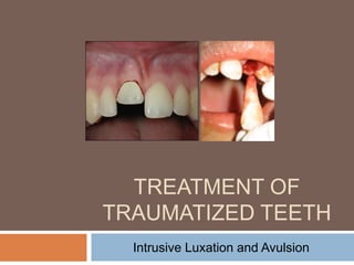 TREATMENT OF
TRAUMATIZED TEETH
Intrusive Luxation and Avulsion
 