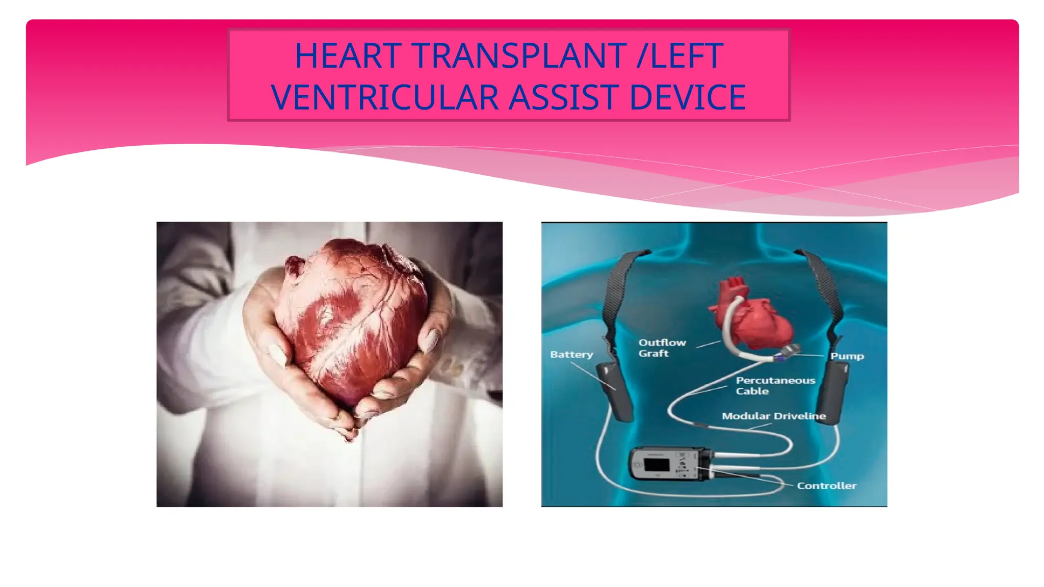 HEART TRANSPLANT /LEFT
VENTRICULAR ASSIST DEVICE
 