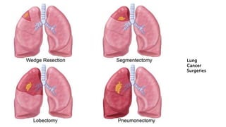 Treatment options for lung cancer | PPTX