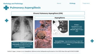 Manod Sign treatment option in fungal pneumonia.pdf