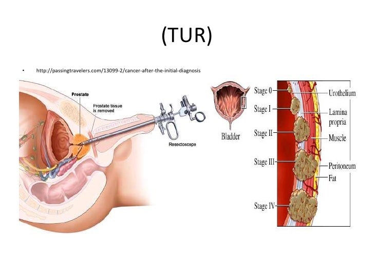 Treatment Options For Invasive Bladder Carcinoma