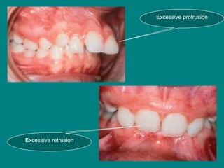 Protusion Defect Treatment Planning in Orthodontics | PPT