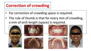 Correction of crowding
• For correction of crowding space is required.
• The rule of thumb is that for every mm of crowding,
a mm of arch length (space) is required.
 