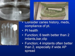 Consider caries history, meds, compliance of pt. Pt health Function; 6 teeth better than 2 imlants,bar,clip Function; 4 implants often better than 2, especially if wide AP spread 