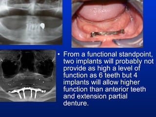 From a functional standpoint, two implants will probably not provide as high a level of function as 6 teeth but 4 implants will allow higher function than anterior teeth and extension partial denture. 