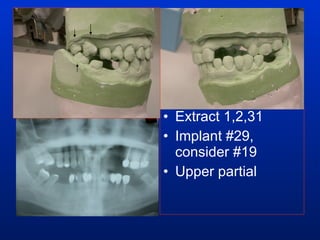 Extract 1,2,31 Implant #29, consider #19 Upper partial 