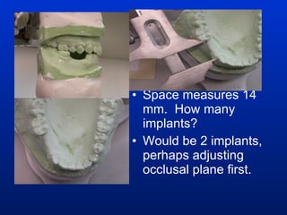 Space measures 14 mm.  How many implants? Would be 2 implants, perhaps adjusting occlusal plane first. 