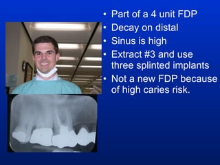 Part of a 4 unit FDP Decay on distal Sinus is high Extract #3 and use three splinted implants Not a new FDP because of high caries risk. 