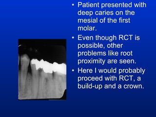 Patient presented with deep caries on the mesial of the first molar. Even though RCT is possible, other problems like root proximity are seen. Here I would probably proceed with RCT, a build-up and a crown. 