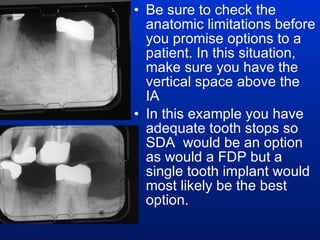 Be sure to check the anatomic limitations before you promise options to a patient. In this situation, make sure you have the vertical space above the IA In this example you have adequate tooth stops so SDA  would be an option as would a FDP but a single tooth implant would most likely be the best option. 