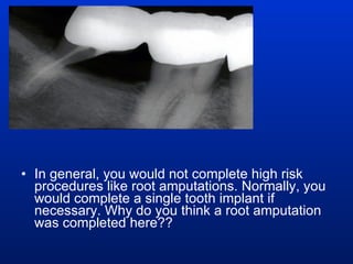 In general, you would not complete high risk procedures like root amputations. Normally, you would complete a single tooth implant if necessary. Why do you think a root amputation was completed here?? 
