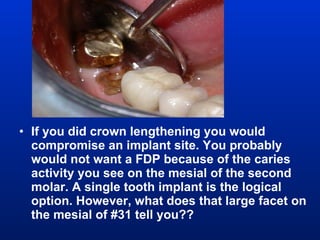 If you did crown lengthening you would compromise an implant site. You probably would not want a FDP because of the caries activity you see on the mesial of the second molar. A single tooth implant is the logical option. However, what does that large facet on the mesial of #31 tell you?? 