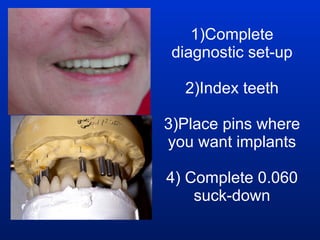 1)Complete diagnostic set-up 2)Index teeth 3)Place pins where you want implants 4) Complete 0.060 suck-down 