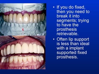 If you do fixed, then you need to break it into segments; trying to have the prosthesis retrievable.  Often lip support is less than ideal with a implant supported fixed prosthesis. 