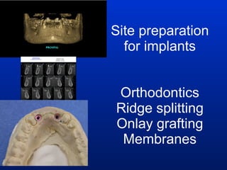 Site preparation for implants Orthodontics Ridge splitting Onlay grafting Membranes 