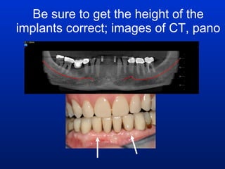 Be sure to get the height of the implants correct; images of CT, pano 
