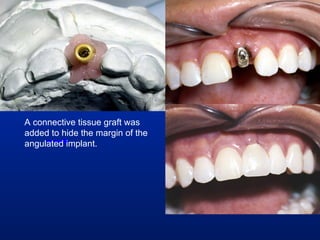 A connective tissue graft was added to hide the margin of the angulated implant. 