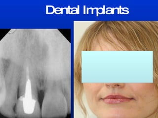 Dental Implants 