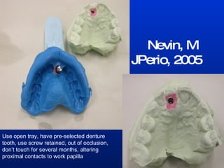 Nevin, M JPerio, 2005 Use open tray, have pre-selected denture tooth, use screw retained, out of occlusion, don’t touch for several months, altering proximal contacts to work papilla . 