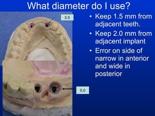 What diameter do I use? Keep 1.5 mm from adjacent teeth. Keep 2.0 mm from adjacent implant Error on side of narrow in anterior and wide in posterior 5.0 3.5 