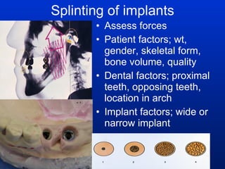 Splinting of implants Assess forces Patient factors; wt, gender, skeletal form, bone volume, quality Dental factors; proximal teeth, opposing teeth, location in arch Implant factors; wide or narrow implant 