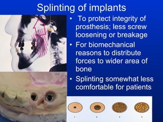 Splinting of implants To protect integrity of prosthesis; less screw loosening or breakage For biomechanical reasons to distribute forces to wider area of bone Splinting somewhat less comfortable for patients 