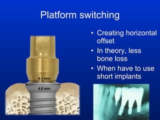 Platform switching Creating horizontal offset In theory, less bone loss When have to use short implants 4.8 mm 4.1 mm 
