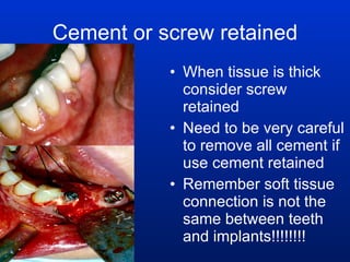 Cement or screw retained When tissue is thick consider screw retained Need to be very careful to remove all cement if use cement retained Remember soft tissue connection is not the same between teeth and implants!!!!!!!! 