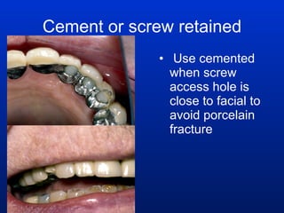 Cement or screw retained Use cemented when screw access hole is close to facial to avoid porcelain fracture 