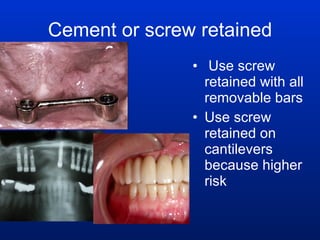 Cement or screw retained Use screw retained with all removable bars  Use screw retained on cantilevers because higher risk 