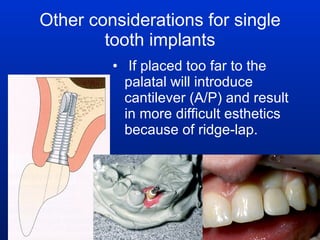 Other considerations for single tooth implants If placed too far to the palatal will introduce  cantilever (A/P) and result in more difficult esthetics because of ridge-lap. 